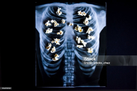 Popcornové plíce: Skryté riziko e-cigaret