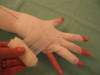 Obvaz ruky s poškozenou tkání